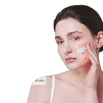 Herbal Acne Face Cream for Scar Removal