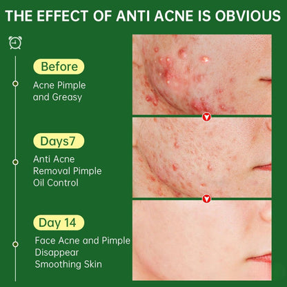 Herbal Acne Face Cream for Scar Removal